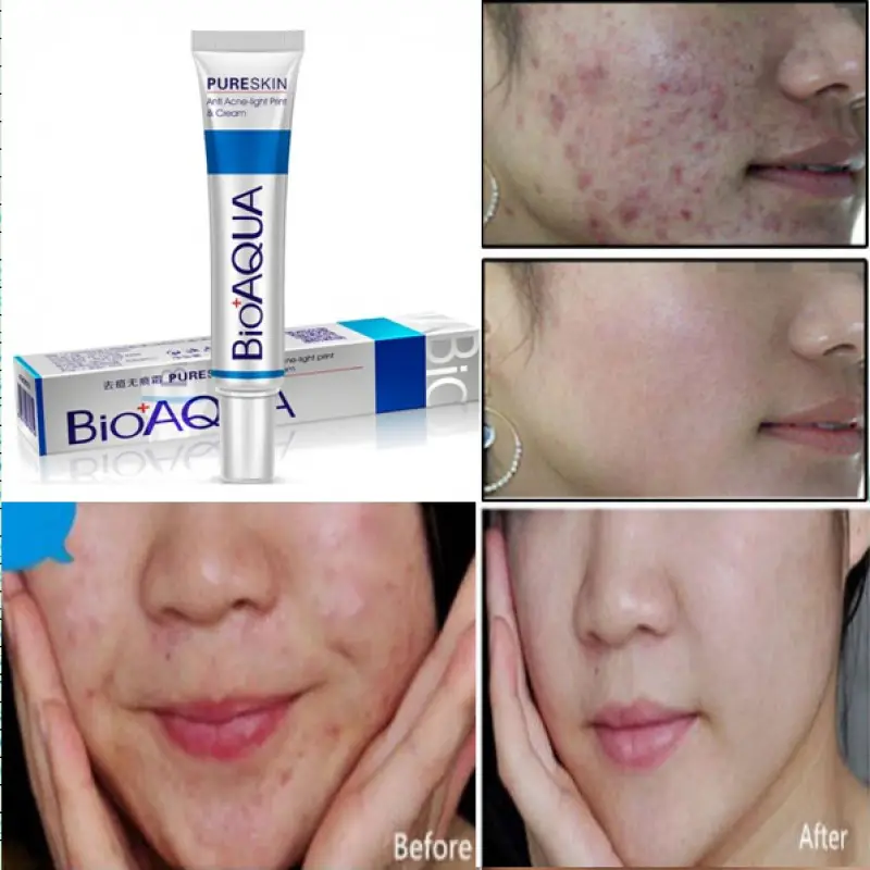 Bio Aqua Acne Removal Cream