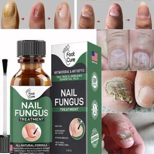 Nail Fungus Treatment Stop Fungal Growth Effective Fingernail 10ml